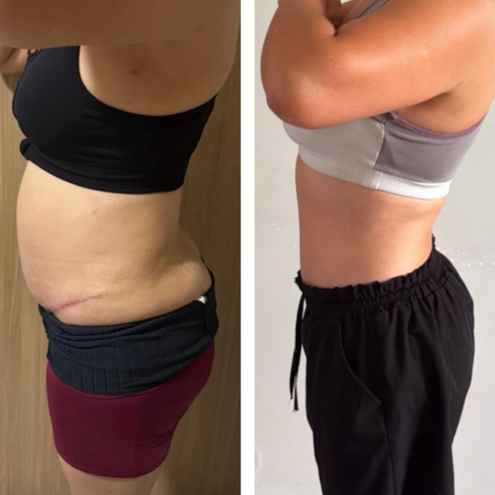 Antes e depois - resultado Afinatto