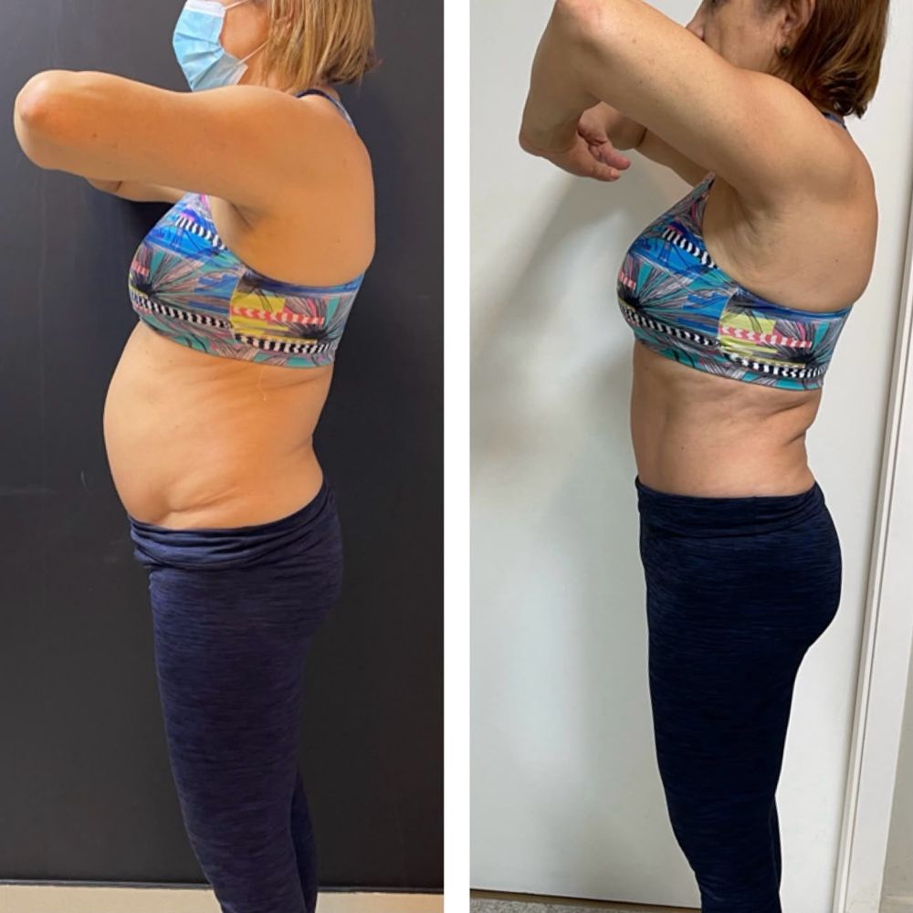 Antes e depois - resultado Afinatto
